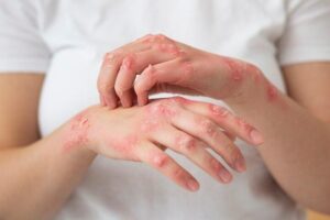 La lepra, una enfermedad antigua y curable (+ infografía )
