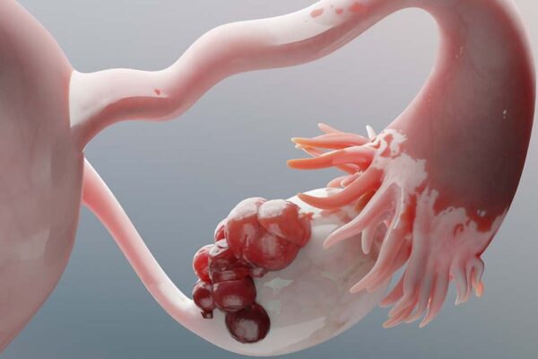 Tendencias mundiales en el cáncer de ovario: un enfoque actual