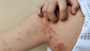 Unirse y Actuar, para eliminar la transmisión de Lepra